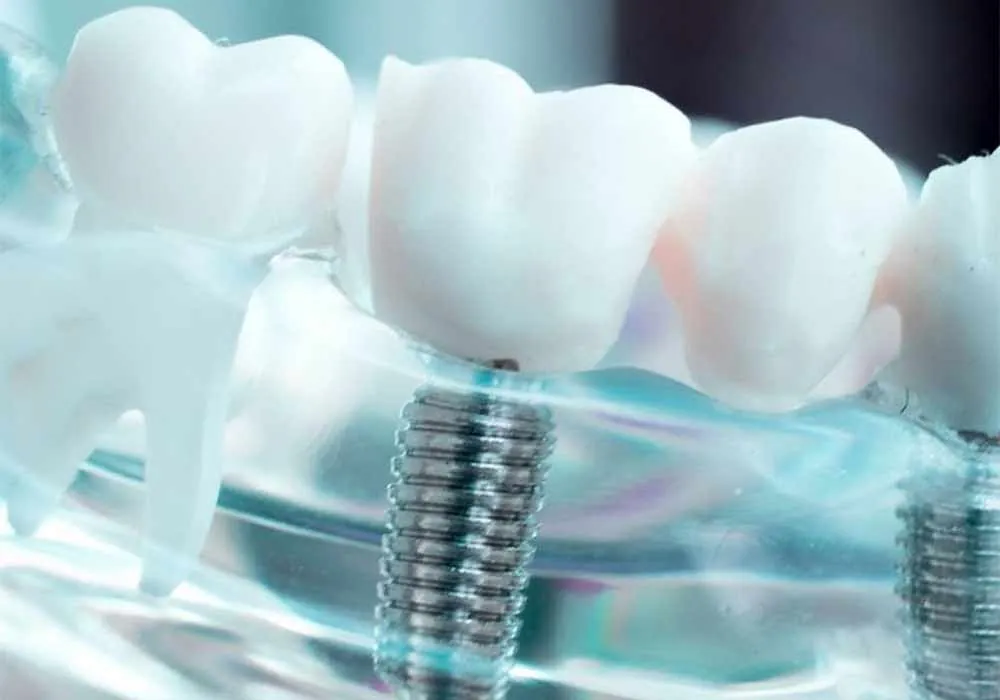 Implantat